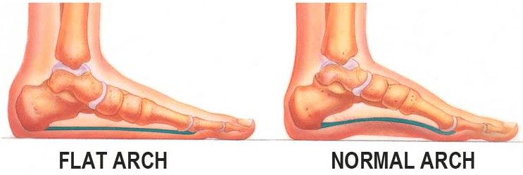 Flat Feet - Rite Gait Orthotics - Custom Orthotics in Milton, ON